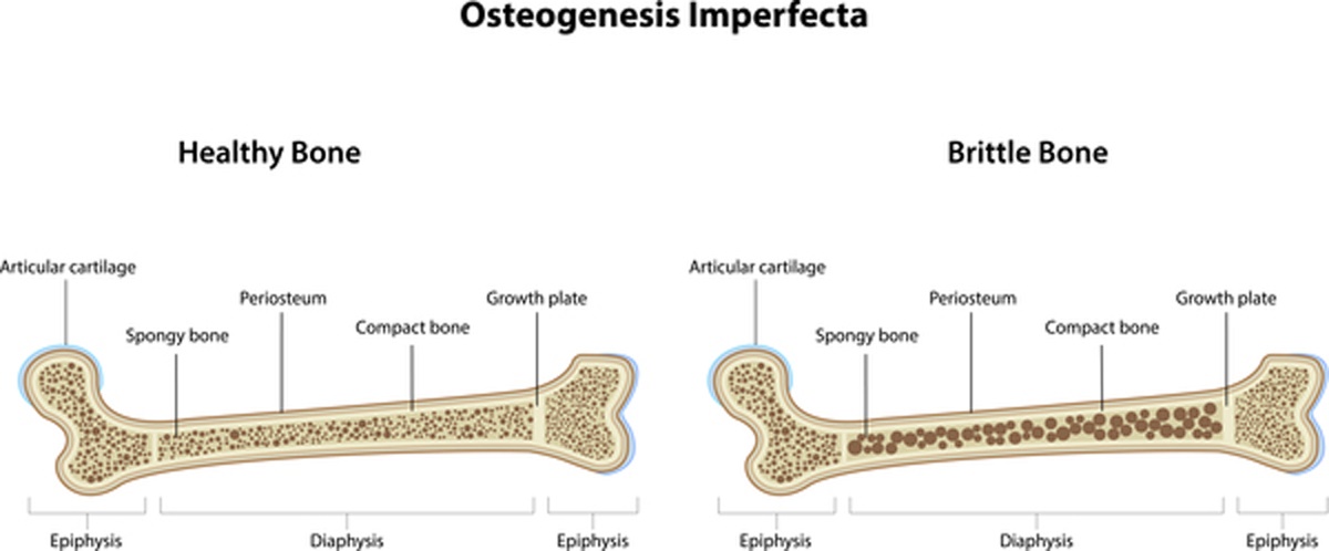 Healthy bone vs brittle bone